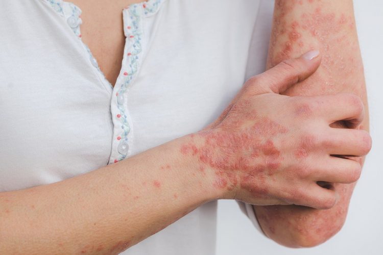 Huile de chanvre pour le psoriasis